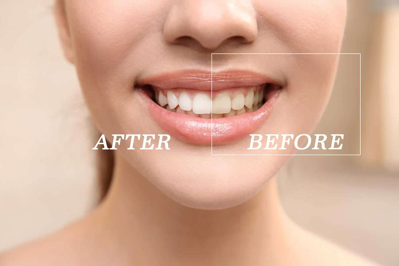 How Can You Maintain a Consistent Smile Shade with Crowns Halifax?