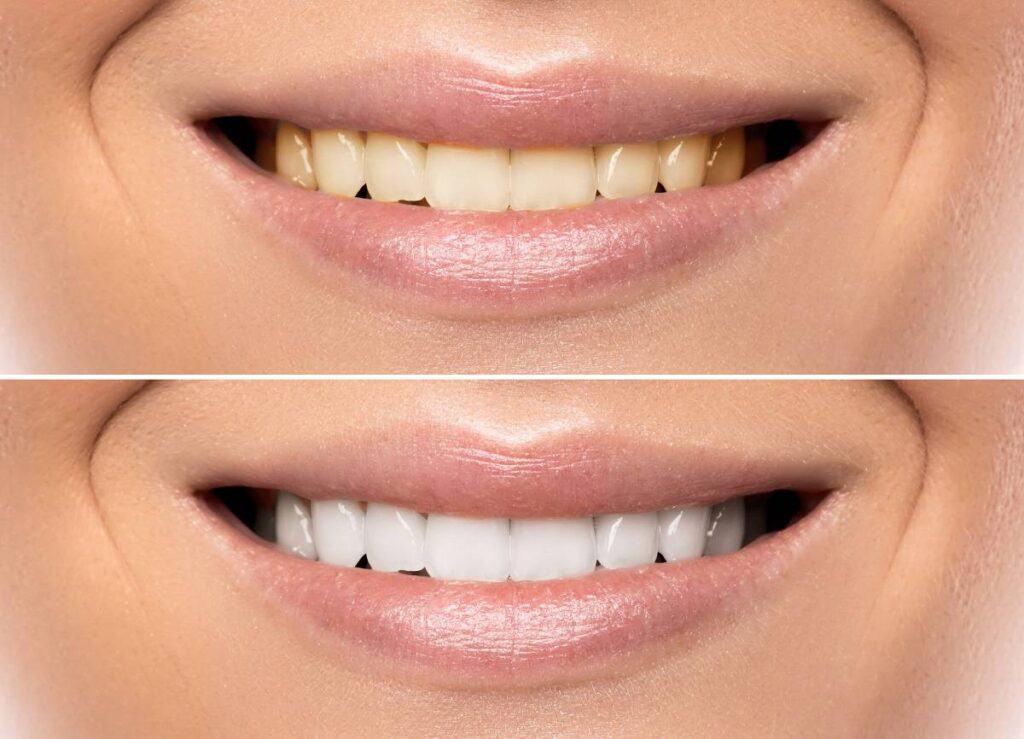 How Can You Protect Your White Smile as a Coffee Lover Halifax?