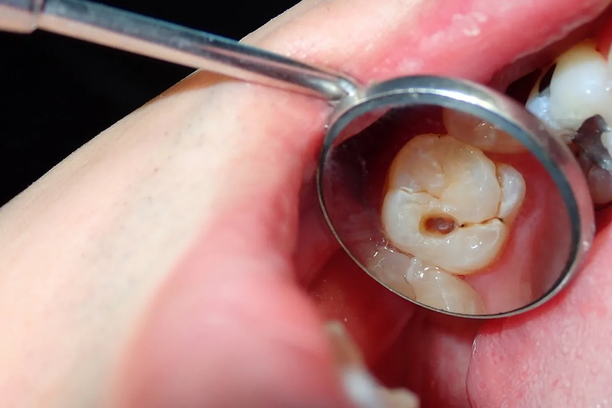Why Do Teeth Crack? Common Causes to Know Halifax