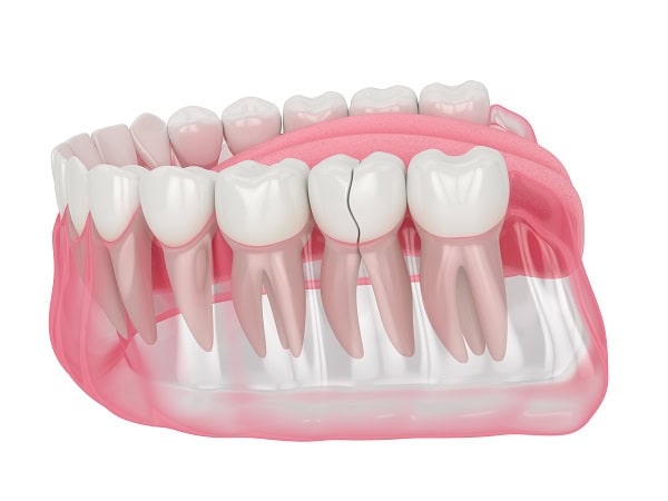 How Can You Manage Pain and Discomfort After a Root Canal Halifax?