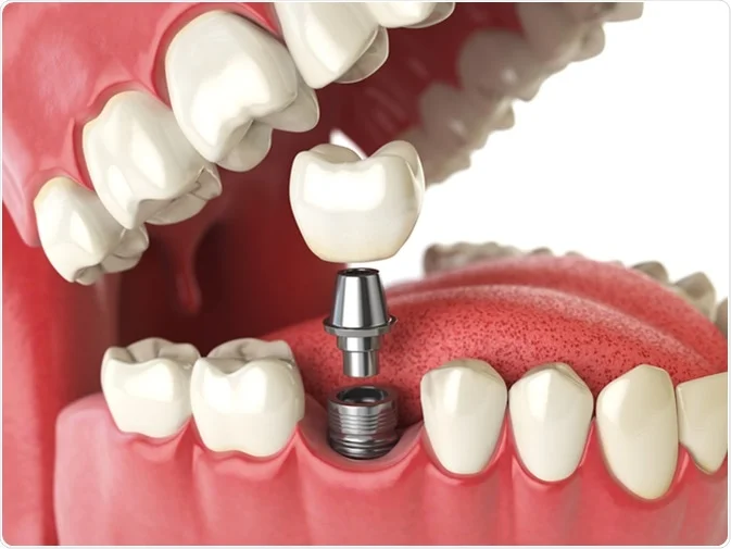 How Do I Decide Which Tooth Replacement Is Right for Me Halifax?