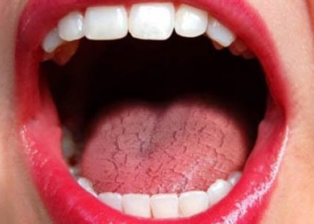 Common Causes of Dry Mouth (Xerostomia) Halifax
