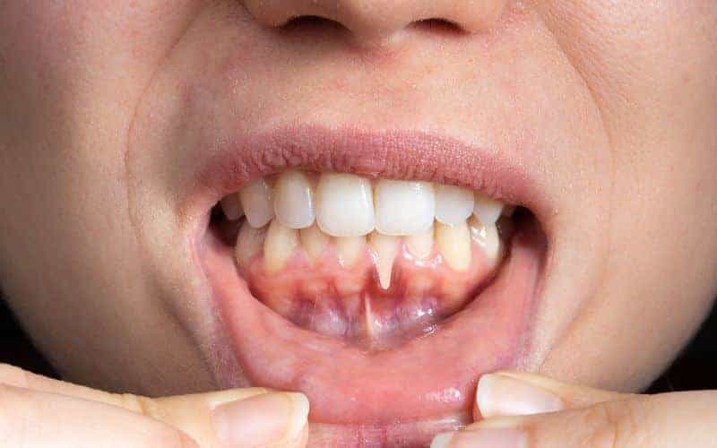 How Can Gum Disease Be Prevented Halifax?