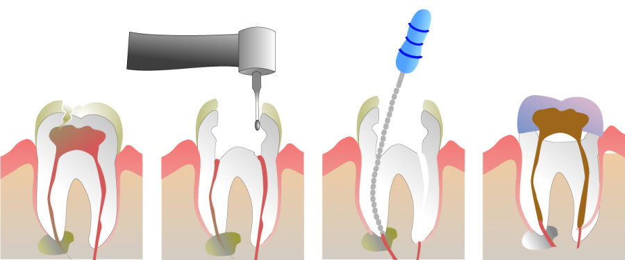 How Do You Properly Care for Your Teeth After a Root Canal Halifax