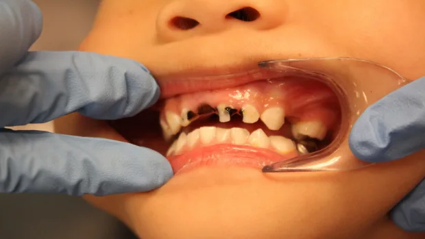 Which Foods and Drinks Cause the Most Damage to Young Smiles Halifax?