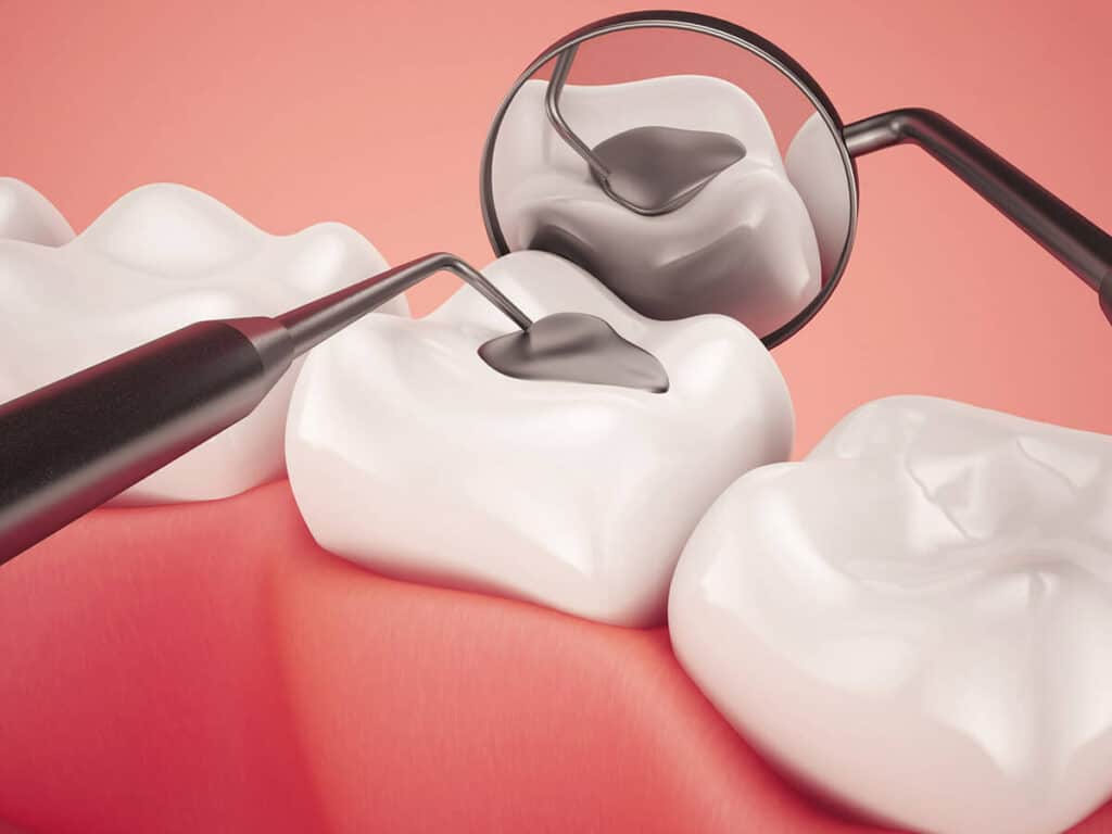 Fighting Cavities and Plaque Buildup Halifax