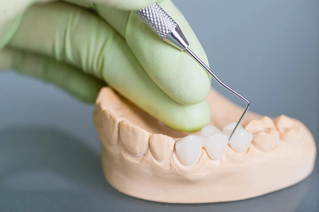 What Are the Different Types of Dental Crowns Available Halifax?