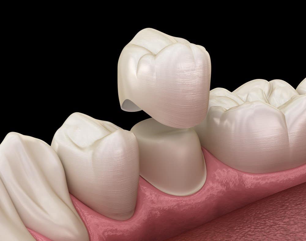 What Daily Habits Help Protect Your Dental Crowns Halifax?