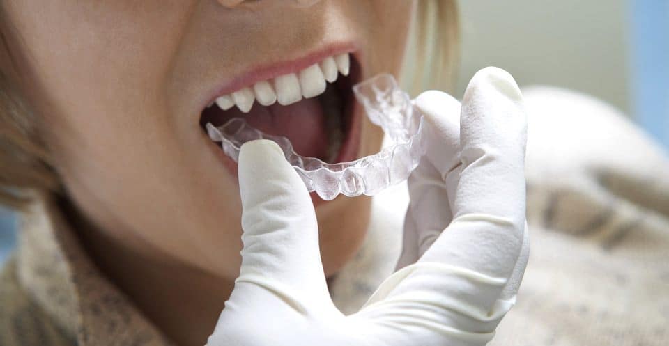 How Much Does Laser Teeth Whitening Cost Compared to Overnight Trays Halifax?