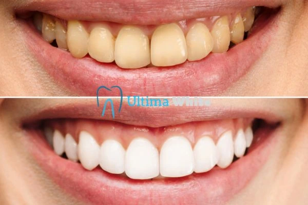 Oral Care Tips for Current and Former Smokers Halifax