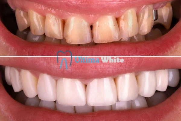 What Makes Instant Teeth Whitening Treatments So Popular Halifax?